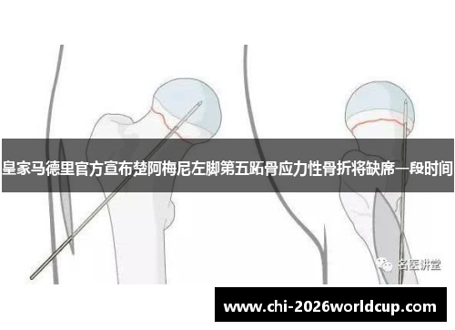 皇家马德里官方宣布楚阿梅尼左脚第五跖骨应力性骨折将缺席一段时间 皇家马德里官方宣布楚阿梅尼左脚第五跖骨应力性骨折将缺席一段时间